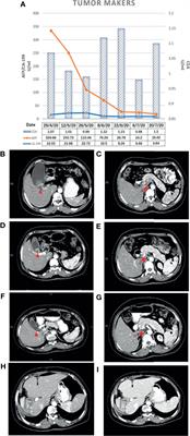 Camrelizumab Combined With Gemcitabine and Albumin-Bound Paclitaxel for Neoadjuvant Therapy in the Treatment of Progressive Gallbladder Cancer: A Case Report